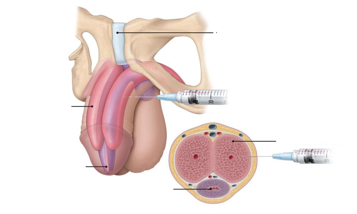 Injections pour augmenter la puissance